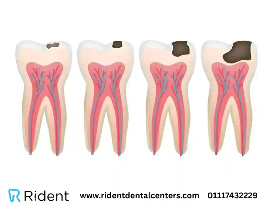 مراحل تسوس الأسنان الـ 5 وعلاجها